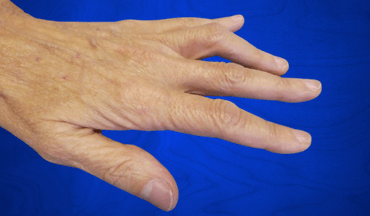 Artritis postraumática