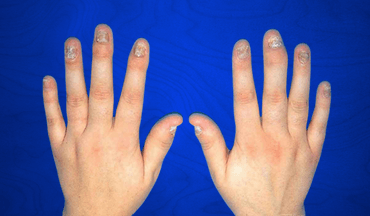 Artritis psoriásica