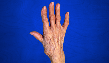 Artrosis trapeciometacarpiana