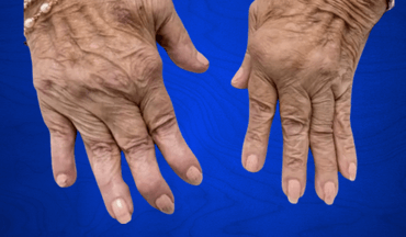 Deformidades articulares severas por artritis avanzada
