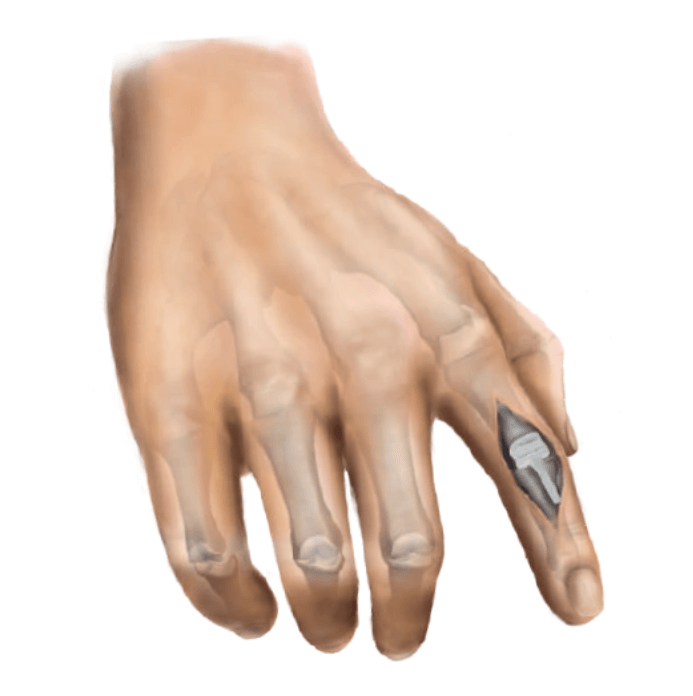 mano con protesis